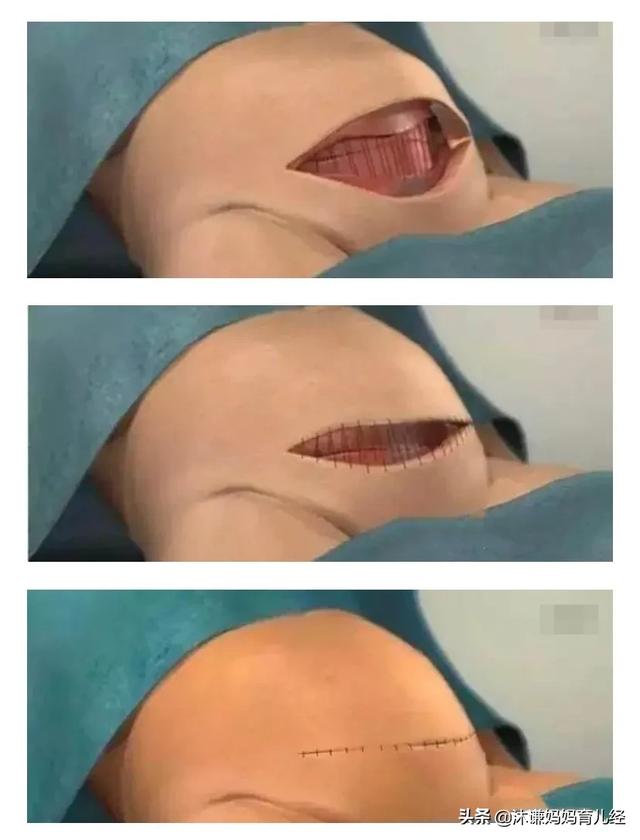 剖腹产后如何尽快恢复元气(二胎剖腹产后元气恢复)