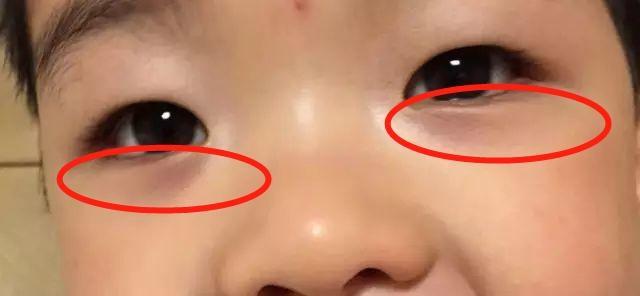 宝宝眼袋发紫,发黑,脾虚已久!健脾胃的"冠军王"食物是什么