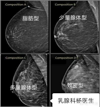 如何辨别脂肪型和乳腺型乳房