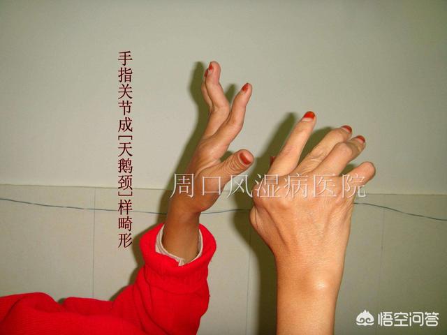 医学上的天鹅颈,你们见过吗_女性知识网-走进女性吧