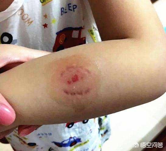 孩子在幼儿园被小朋友咬伤有危险吗