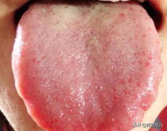 脾虚肝郁湿热重,大便不成形,该如何调理