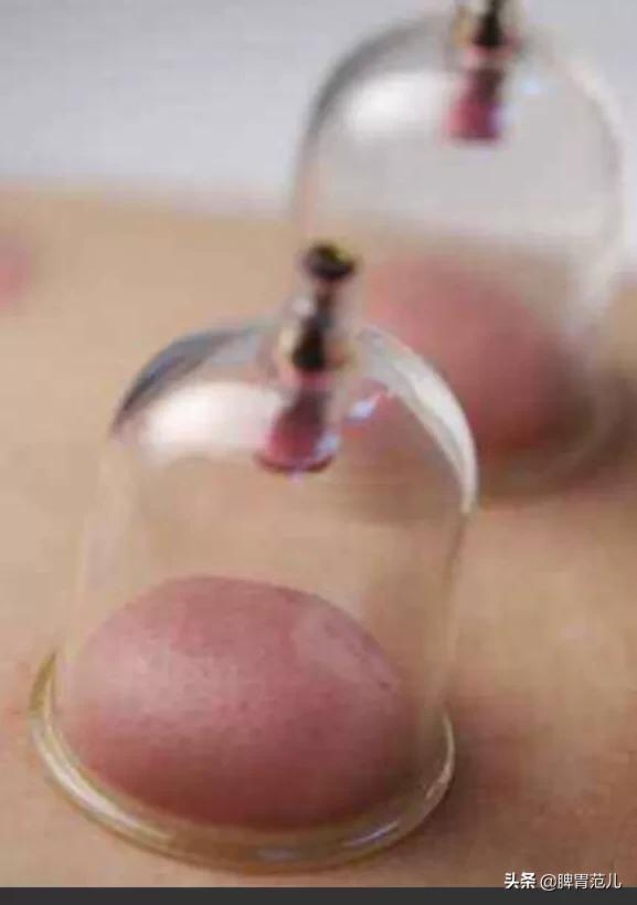 拔罐作为现在很流行的养生方法,很多人都希望能通过拔罐来排毒强身