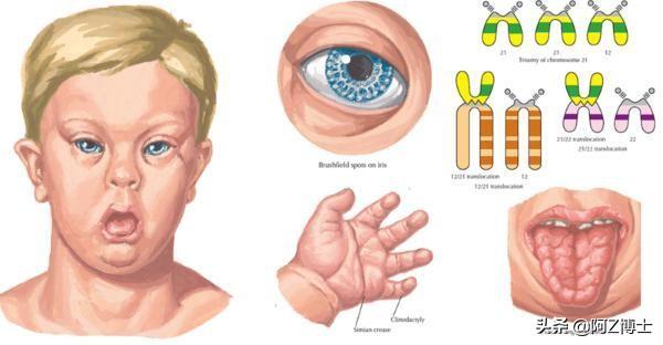 唐氏综合症也叫21-三体综合症,另一个名称也叫先天愚型,是21号染色体