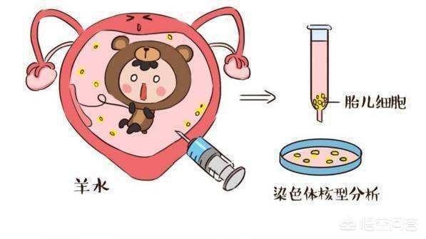 怀孕后NT、唐筛、无创、羊穿,孕妇该如何选择