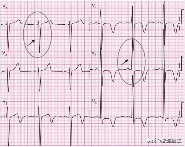 养生心经,心脏不好,应该在饮食注意什么哪些运动对可以锻炼心脏